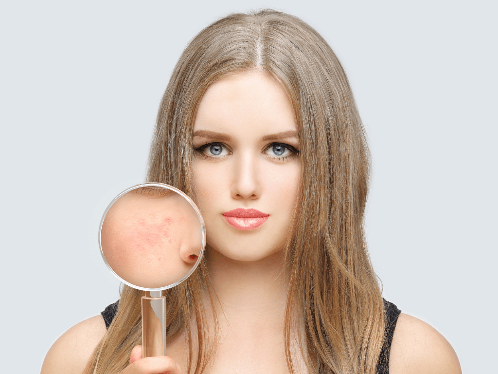 woman with acne and magnifying glass